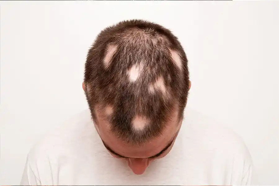 علائم و نشانه‌های ریزش مو سکه ای